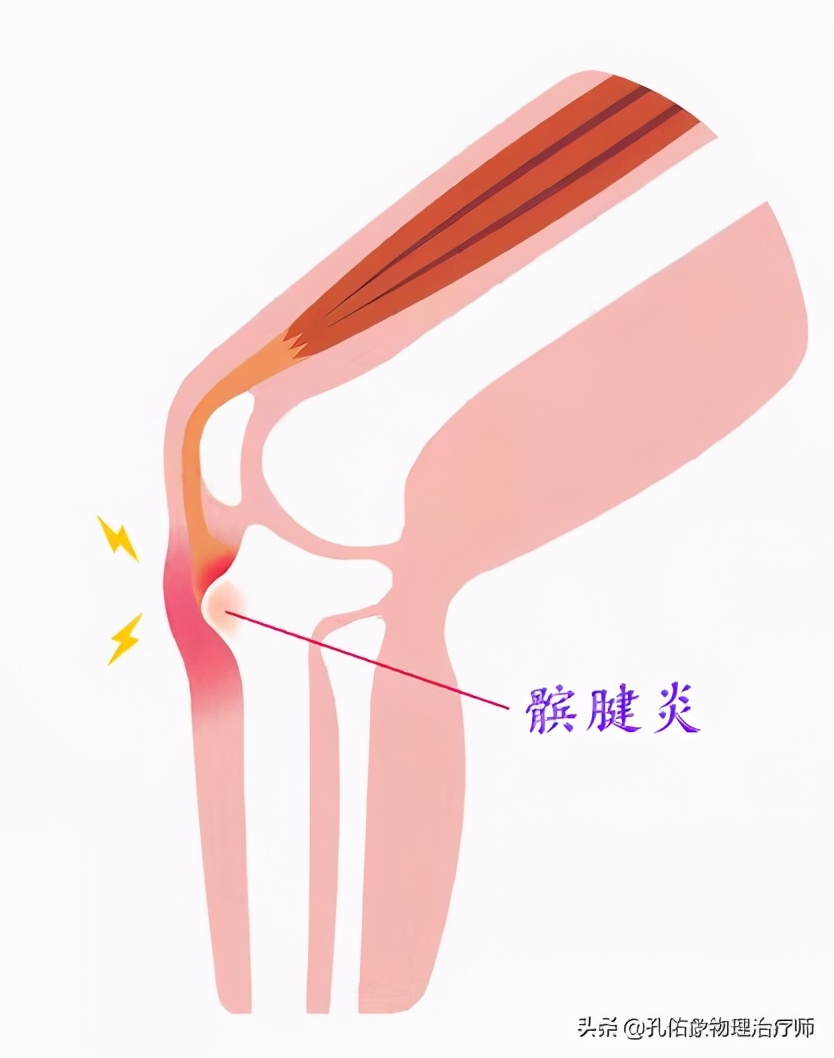 膝关节疼痛是怎么回事？常见的6个部位、8大病因，不可忽视