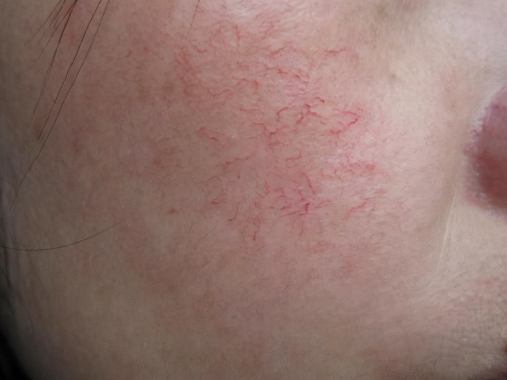 通俗来说就是皮肤太薄,能清晰看到皮肤下扩张的毛细血管,也就是我们平