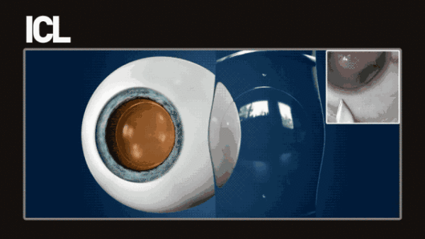 高考升学体检将至，你还在纠结选择哪种手术吗？