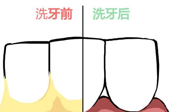 怎样才能够有效、健康的美白牙齿？做牙齿美白贵吗？