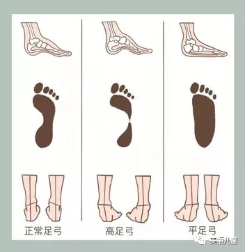 儿行百步母担忧之足部——科学认识学龄儿童扁平足