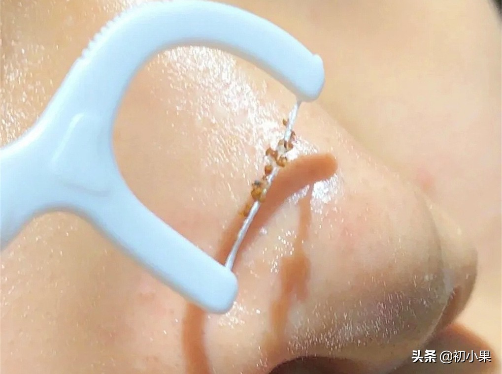 鼻子上的黑头怎么去除