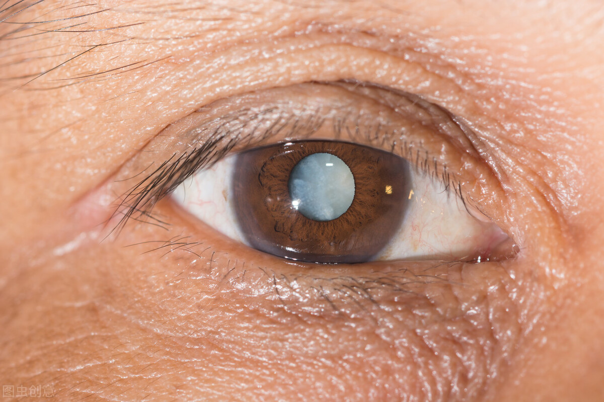 白内障是老人常见病，需要等眼睛失明再治疗吗？别弄错了时机