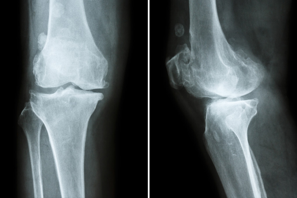 腿痛应该拍X线还是CT或者MRI？为什么医生开的不一样？详细解释