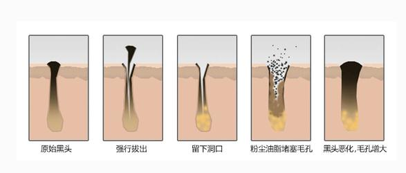 闭口粉刺如何祛除？