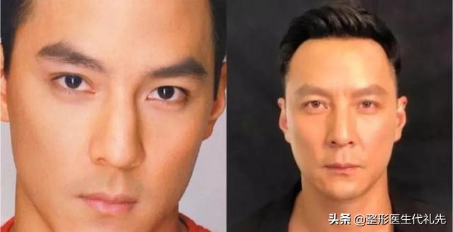 从整形医生角度谈一谈人中长显老，该如何改善？