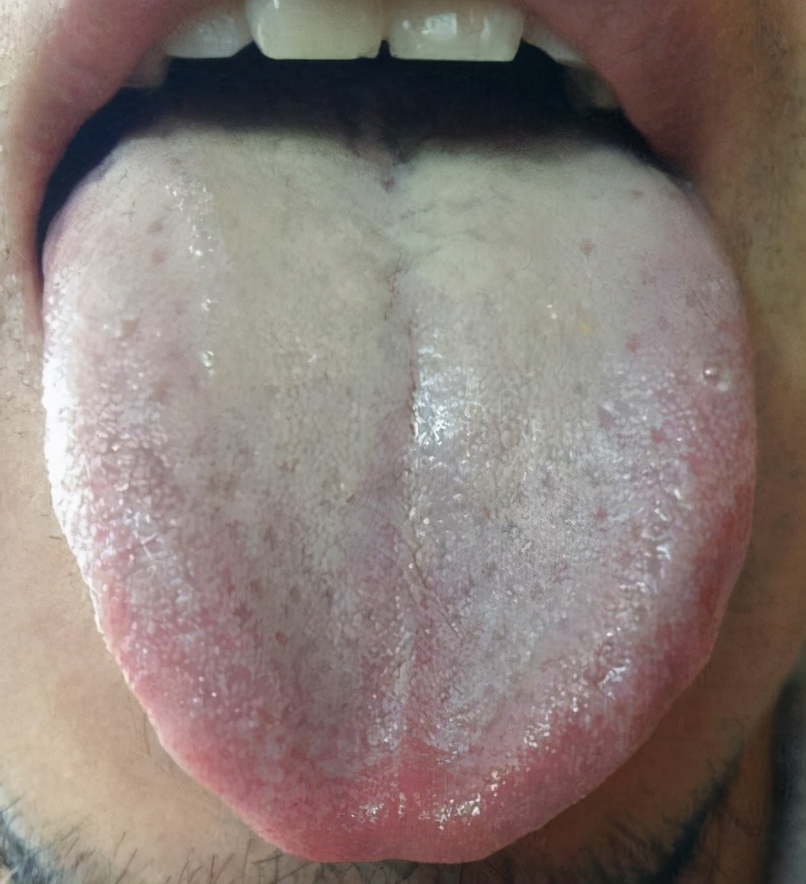 临床上常见的舌象 舌质淡红舌苔白厚 最常见是脾溼,也就是脾虚溼侵