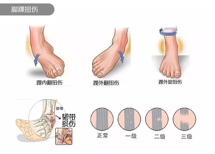 踝关节扭伤,标准处理流程