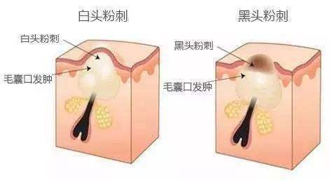 闭口粉刺如何祛除？