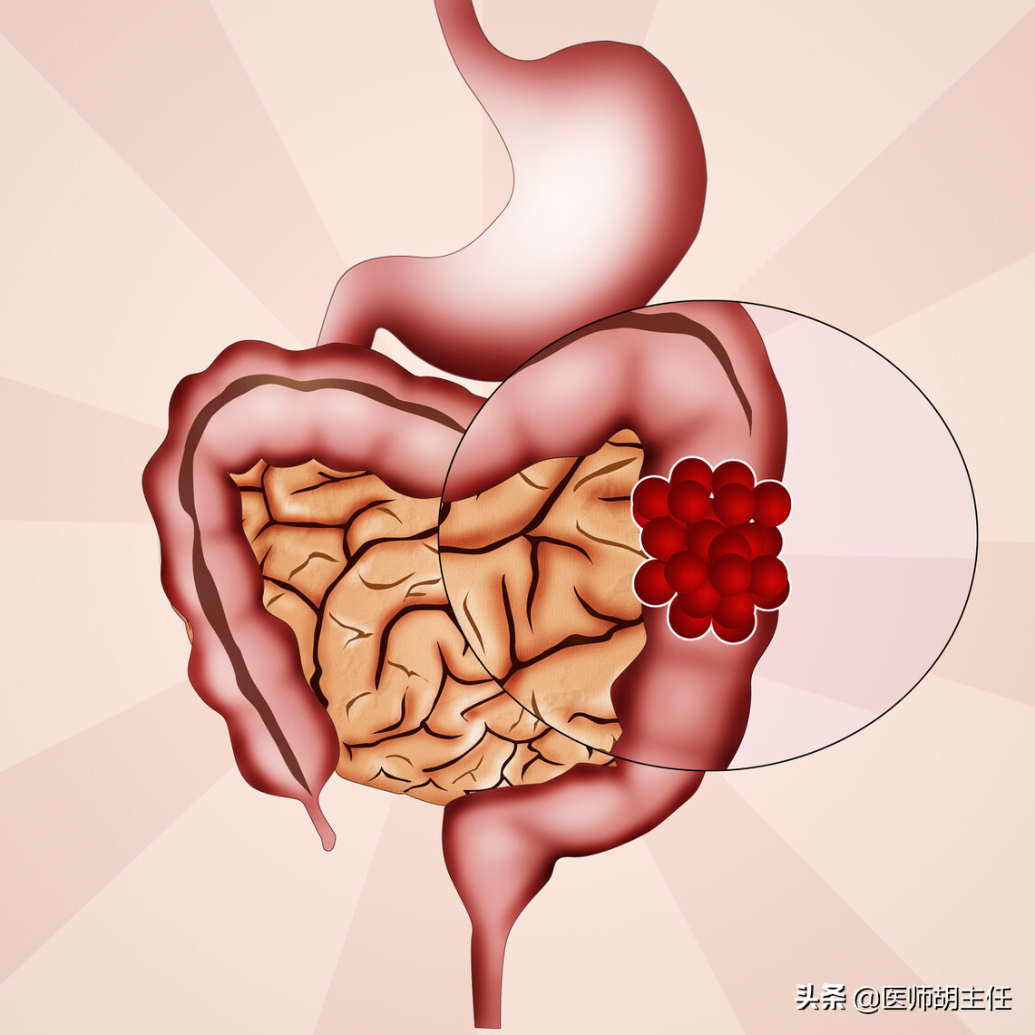 肠内若有"息肉",身体会有什么症状?