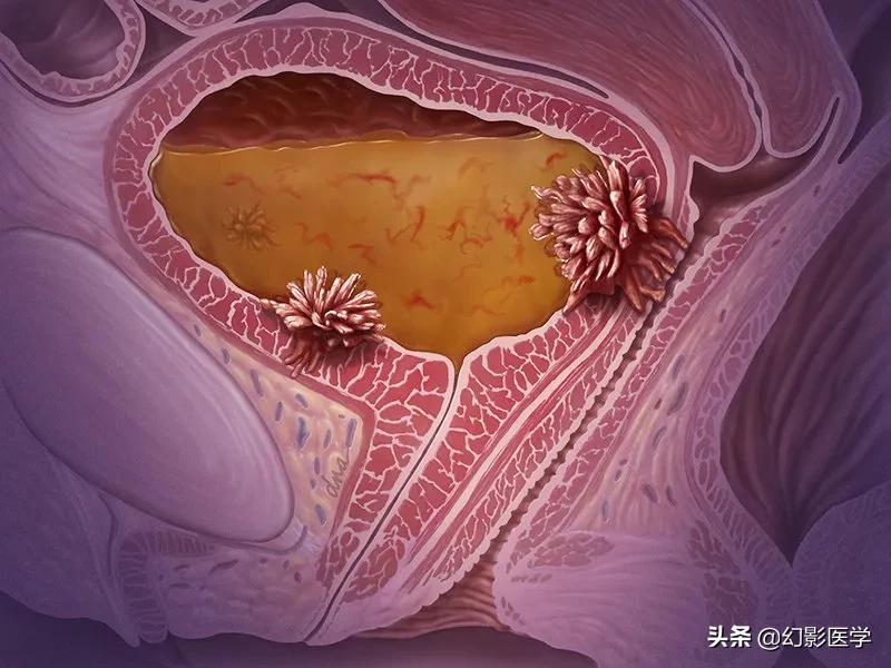 膀胱肿瘤术后如何规范实施灌注化疗，建议收藏