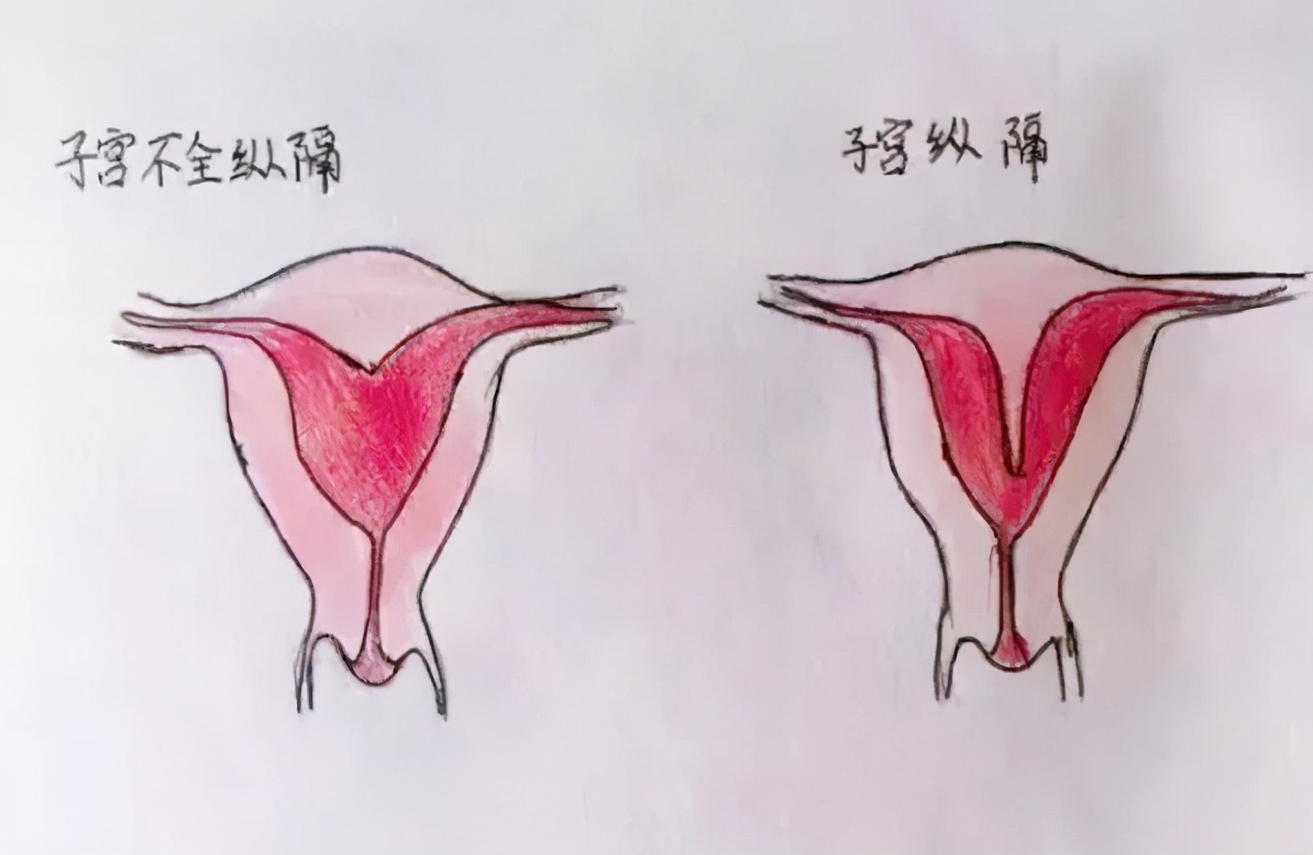 縱隔子宮是指子宮外形正常,但從宮底至宮頸內口或外口有縱隔,根據分隔