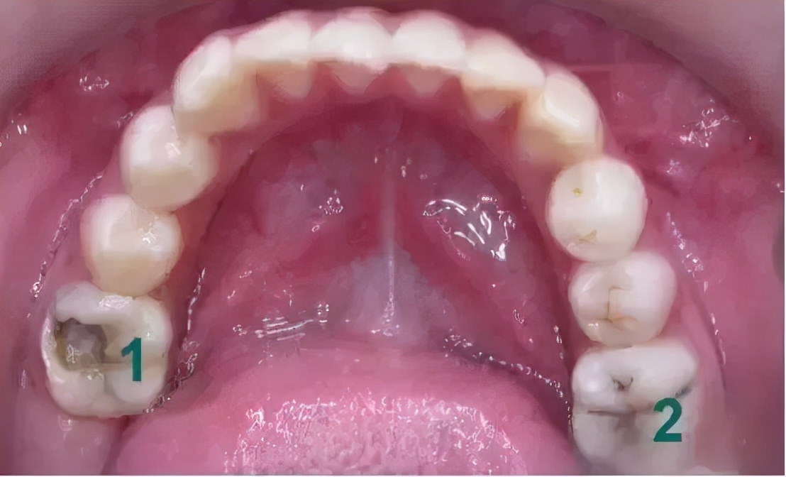 "六龄齿"横空出世,拉开换牙的序幕