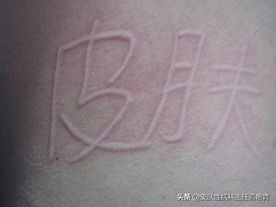 皮肤一抓就红而且凸起怎么办，皮肤一抓就红而且凸