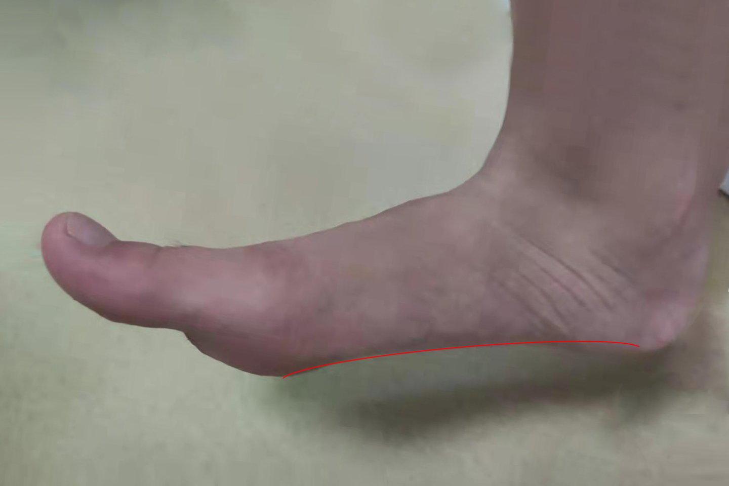 你为何需要足弓？这篇文章告诉你为何扁平足走路会疼痛