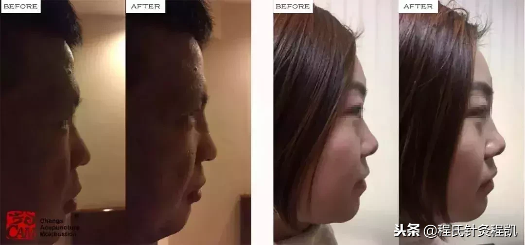别在脸上乱动刀子了!这个风靡日本的美容秘技助你重回颜值巅峰