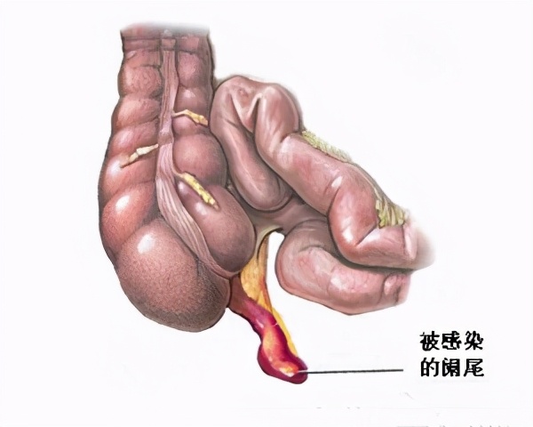 阑尾炎手术治疗，要注意哪些护理事项？