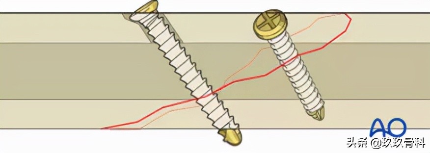 拉力螺钉使用的小技巧