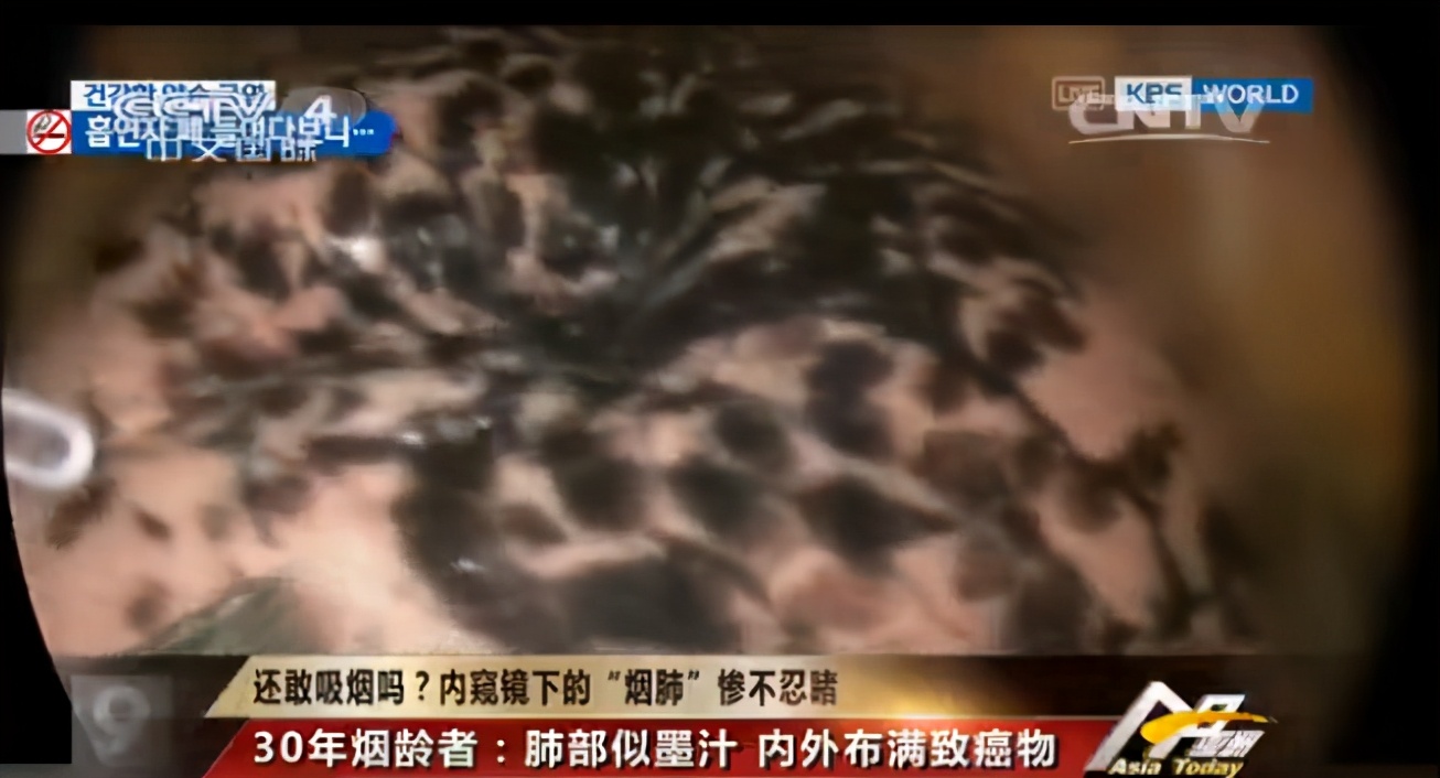 年者的肺部呈现出明显区别:都说吸烟有害健康,这仅仅是用语言的抽象