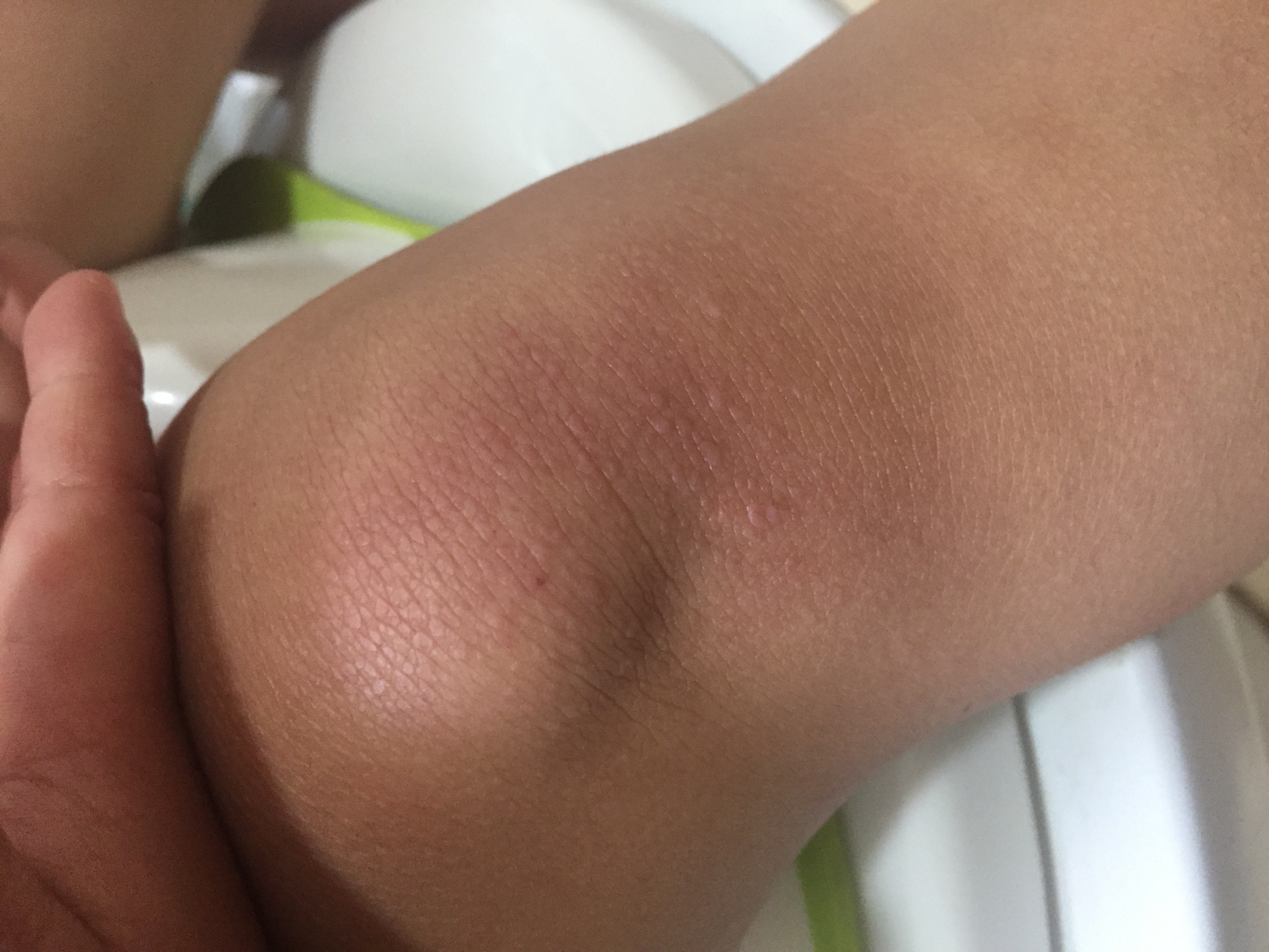 夏天到来,小朋友的皮肤出现小丘疹,这是什么病?