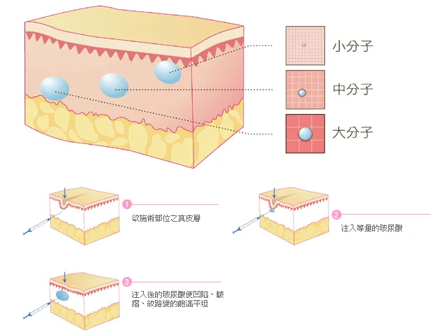 可用于面部填充的材料都有哪些?