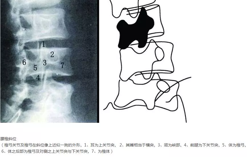 从诊断到治疗：全面解析腰椎峡部裂(lumbar spondylolysis)