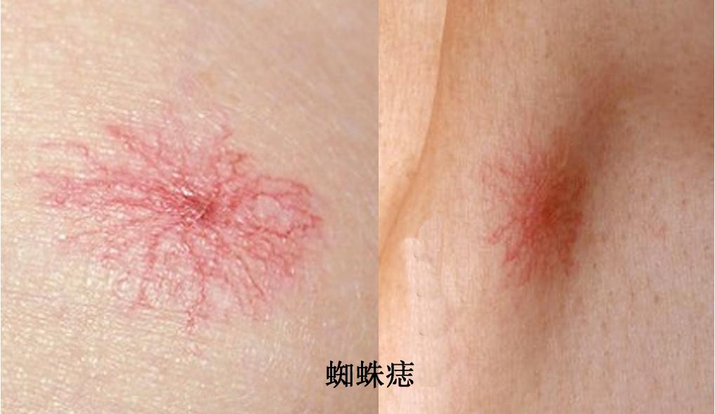 肝病患者长"红痣"要格外重视
