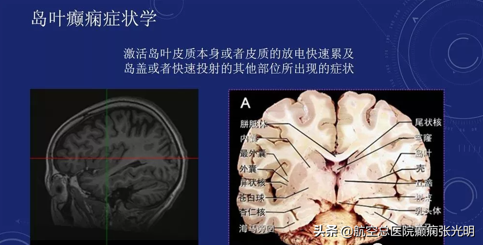 浅谈岛叶癫痫，什么都不像是其症状学特征
