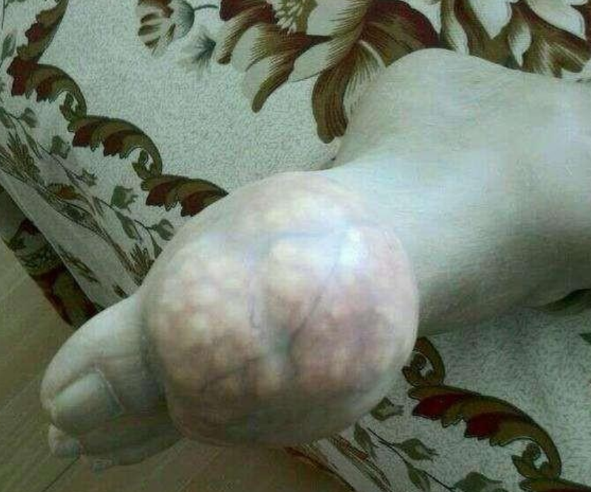 医生从我体内取出一盆石头，都是痛风惹的祸！痛风石怎么治疗？