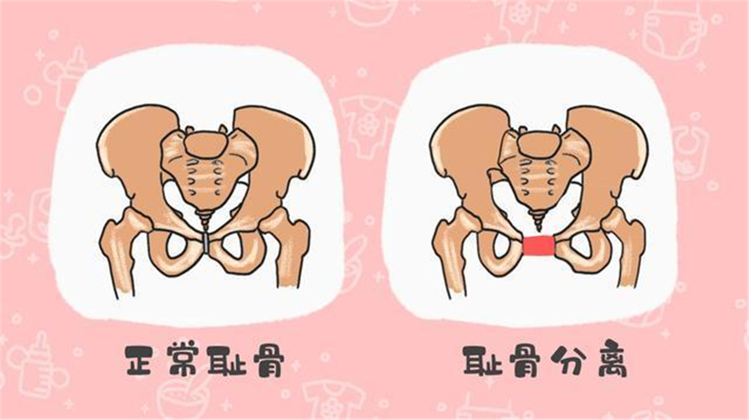 孕期"耻骨"疼到坐也不是站也不是?这五类孕妇,要尤其注意