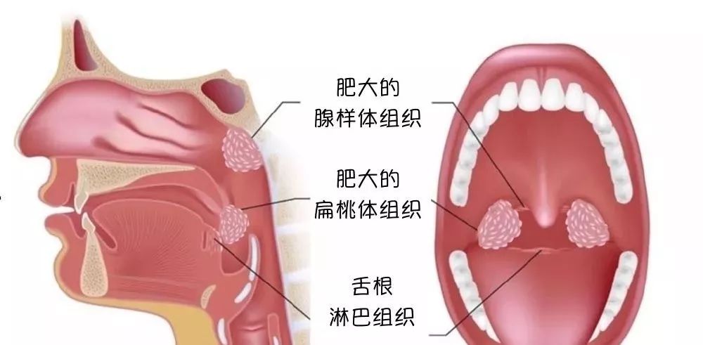 扁桃体/腺样体切不切？耳鼻喉专家告诉你答案