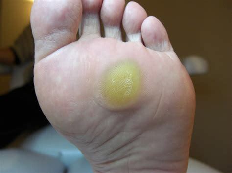 趾疣图片(趾疣图片 鸡眼) - 盾灵网