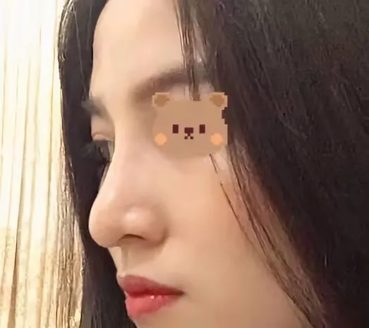 隆鼻后的美貌,难道只是“限定款”吗?