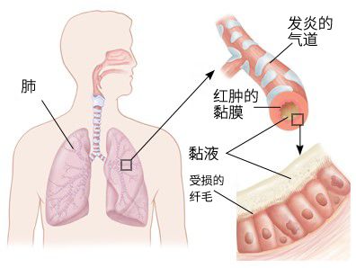 宝宝吐黄绿痰是细菌感染了吗？解答你关于痰的 5 个疑问