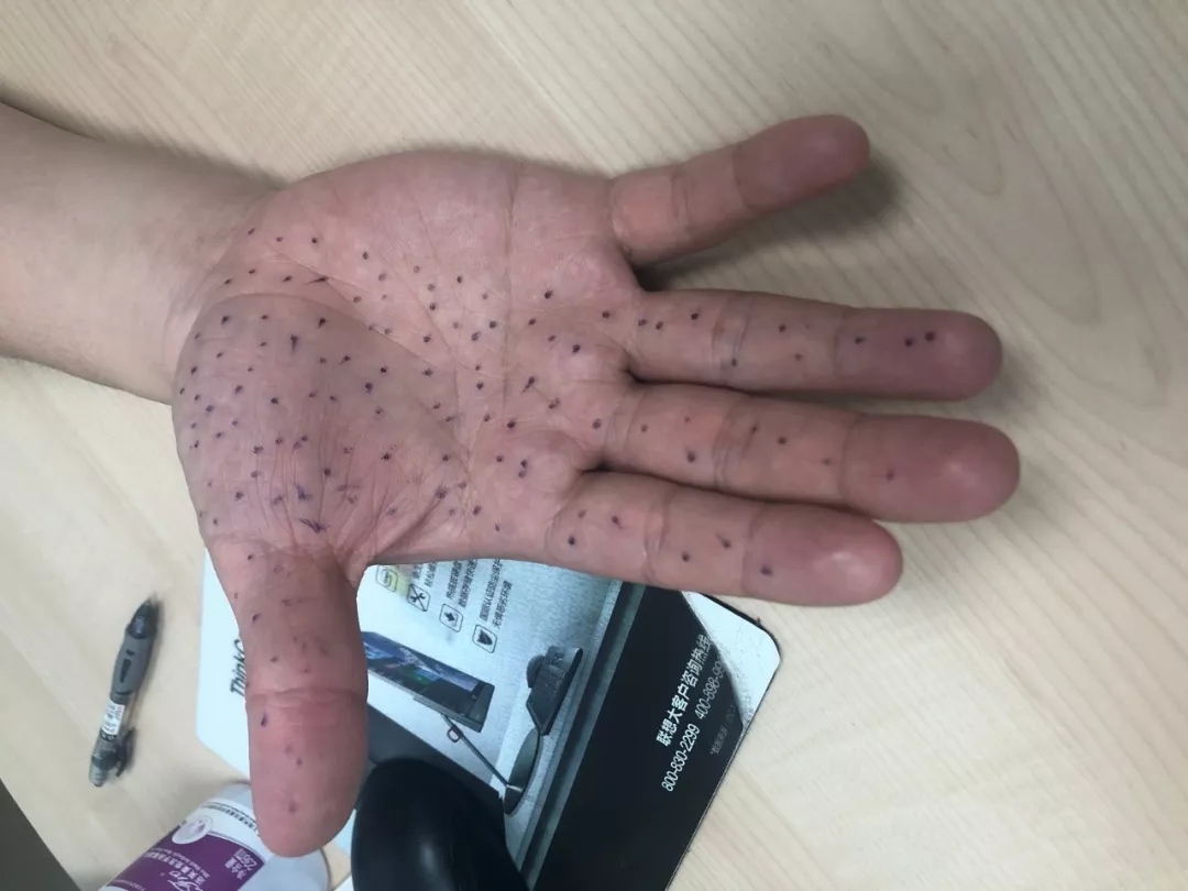 医林正骨丨名医慧眼破真凶，手麻手痛有它因