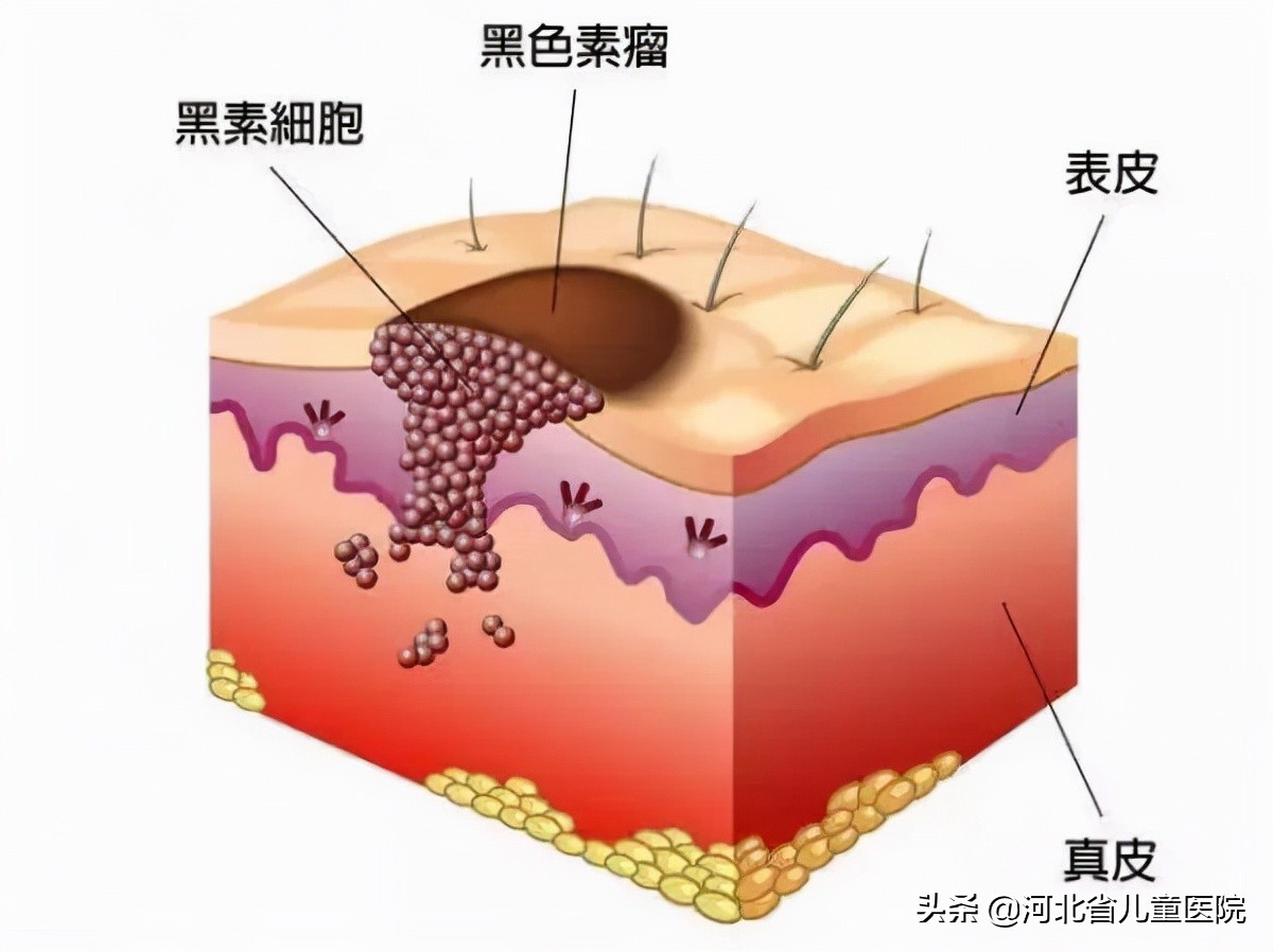 黑痣，危险️！什么情况？