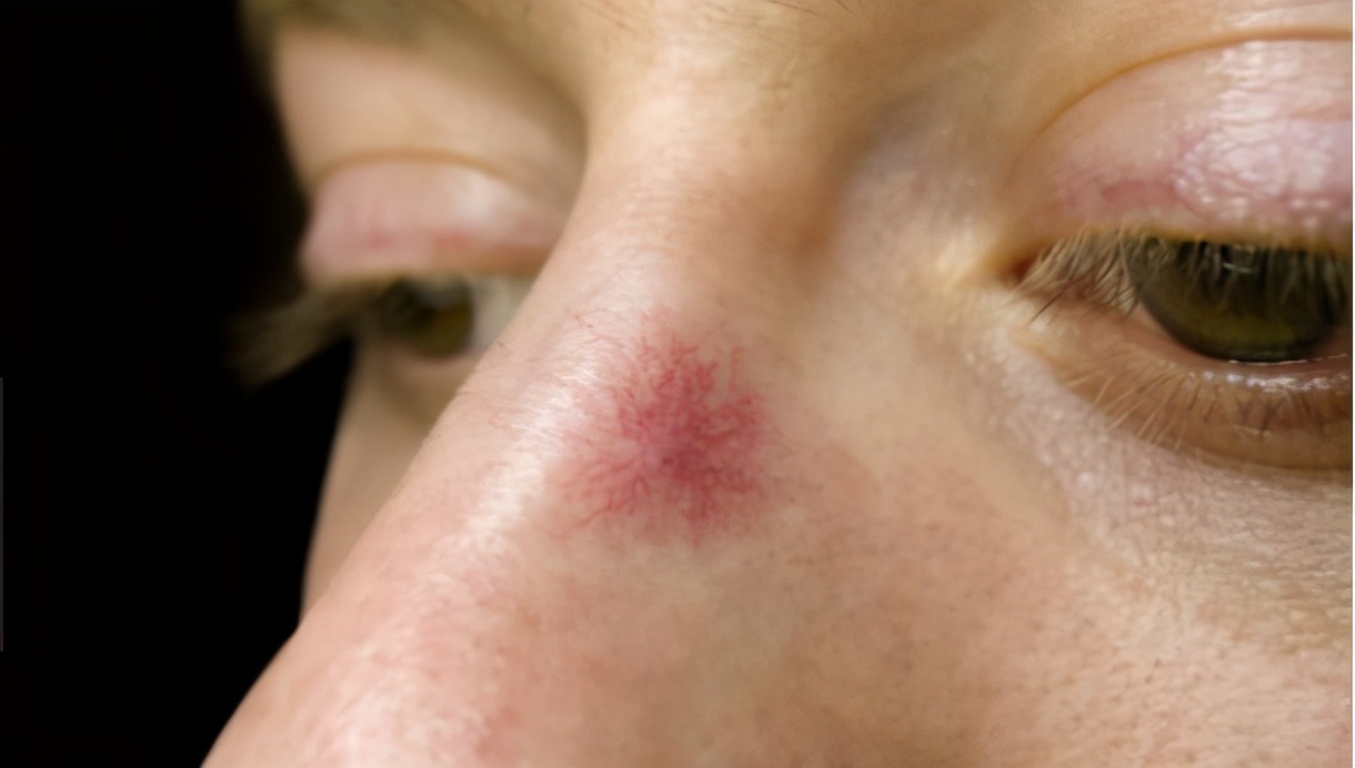 如何判断蜘蛛痣?身上长了蜘蛛痣,一定就是肝脏出了问题吗?