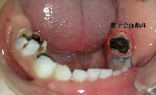 90%的孩子都有蛀牙：别再让孩子补牙，这个方法更有效