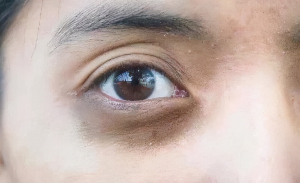 二,严重的黑眼圈从而会影响我们面部的肤色,皮肤会逐渐变暗甚至发黑