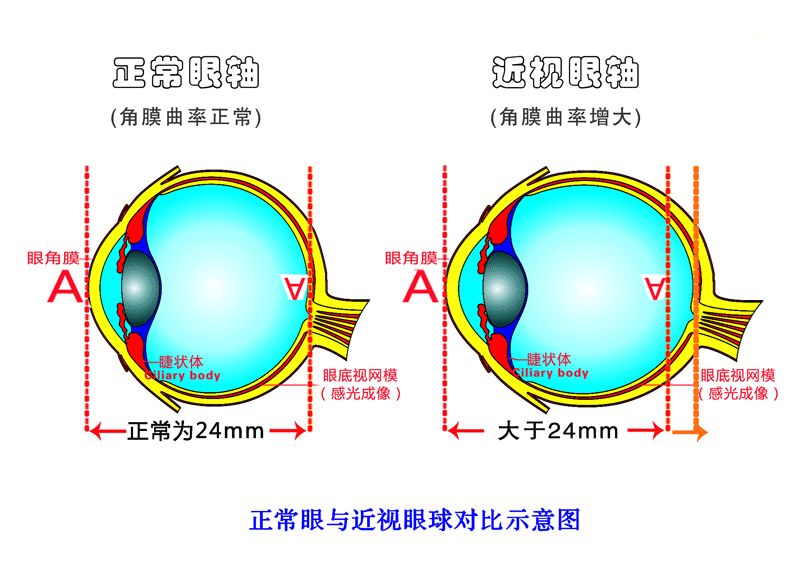 近视手术可以拯救你凸出的“金鱼眼”吗？