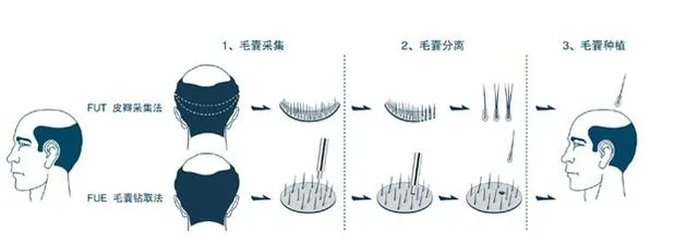植发太贵,雷军吐槽“每个人头顶着一栋别墅”,植发经济了解下?