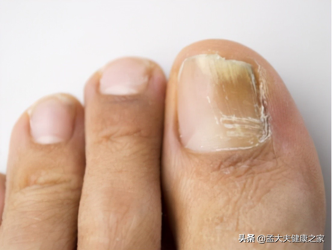 得了灰指甲怎么治？2个治疗方法效果好，安全不复发