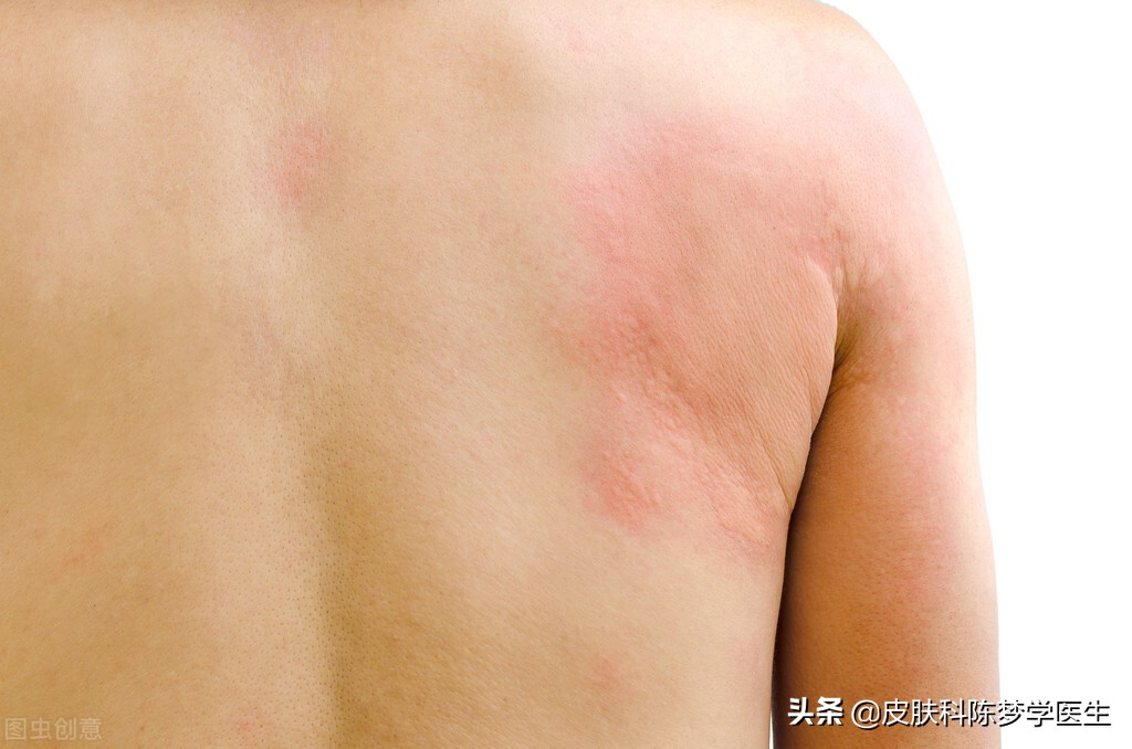 痒！痒！痒！得了荨麻疹，该怎么办？