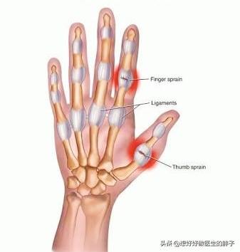 排球手指受伤怎么处理(手指打篮球挫伤了，半年不恢复，还肿着，听听医生给您的治疗建议)