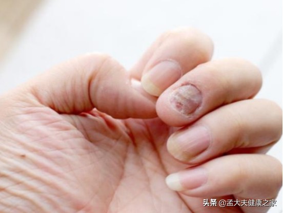 得了灰指甲怎么治？2个治疗方法效果好，安全不复发