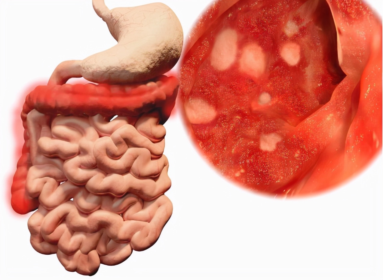 一天放屁數十次是大腸癌嗎？醫生直言：伴隨四個跡象，千萬別大意