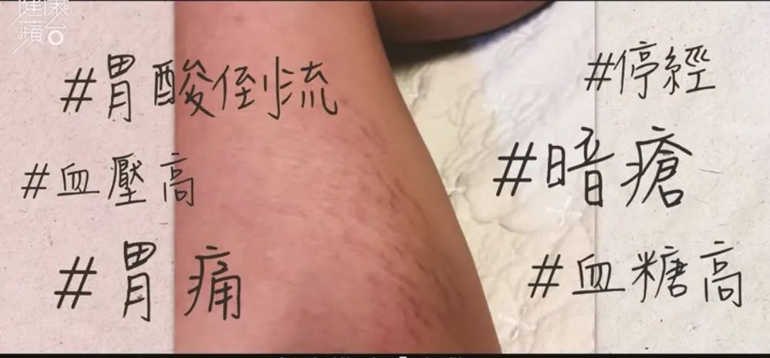 00后英国留学患病暴肥19kg，停止减肥才是出路？
