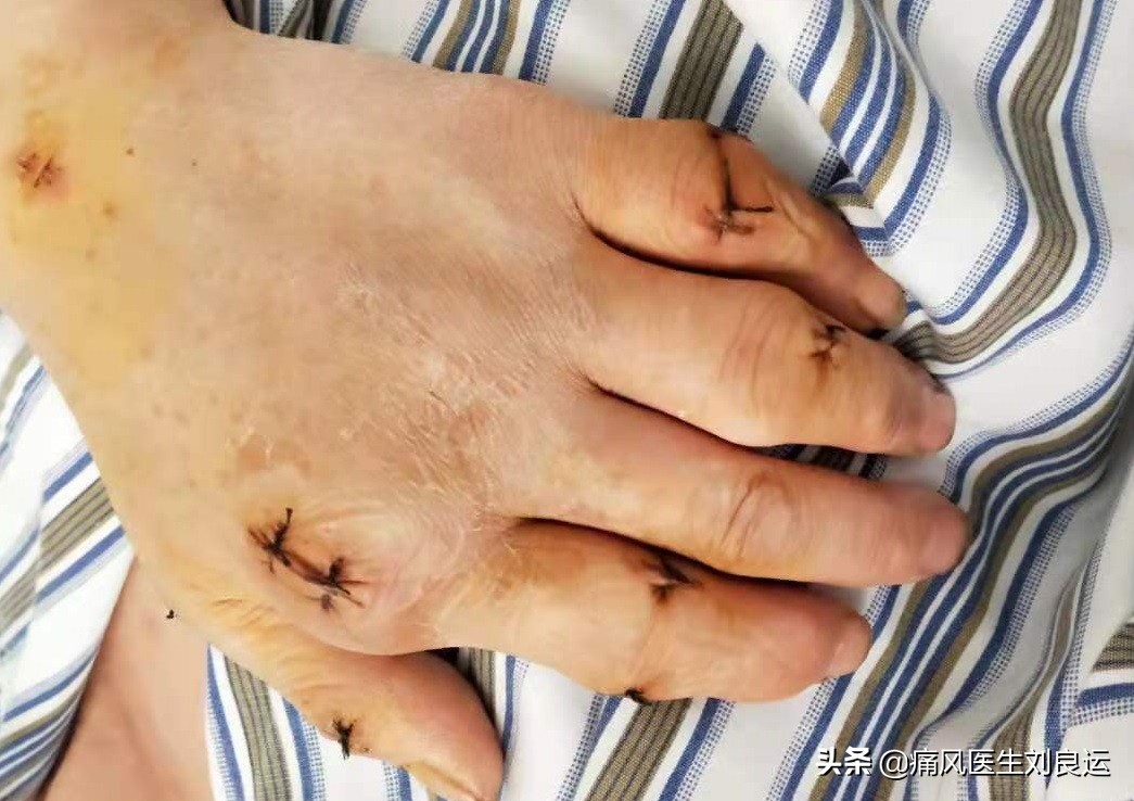 痛风患者都会长出痛风石吗？医生介绍痛风石治疗的四种方法