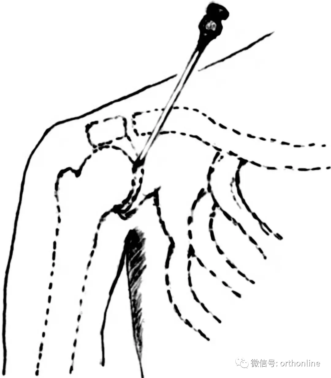 临床实用 | 关节穿刺技术分享