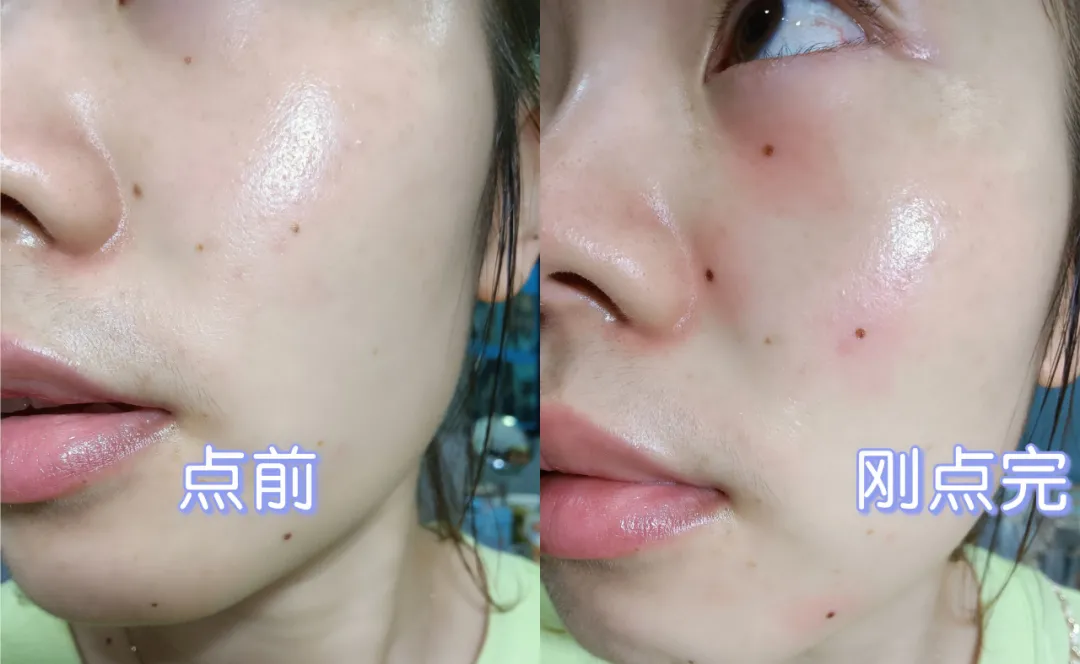 痣多星人的药水点痣分享,点完不忌口,离变美又近了一步